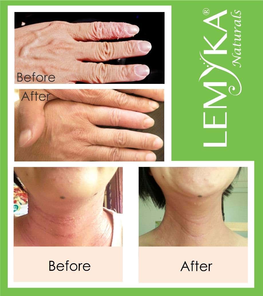 Michaderm Lemyka Eczema Flare Defense Calming Cream 3-Pack Bundle (photo 4)